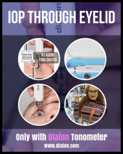 Embracing Innovation in Glaucoma Screening: The Diaton Digital Tonometer Revolution