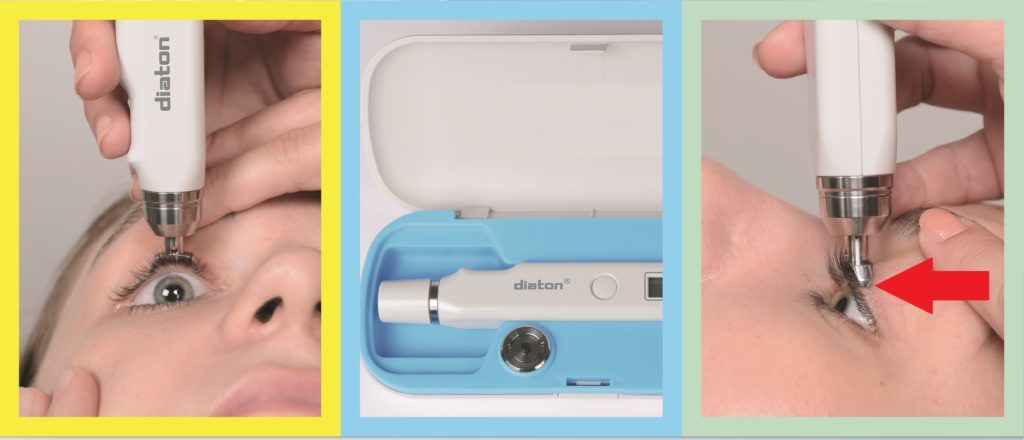 Transpalepbral Diaton Tonometer - IOP Through Eyelid Tonometry, quick and painless IOP for glaucoma detection